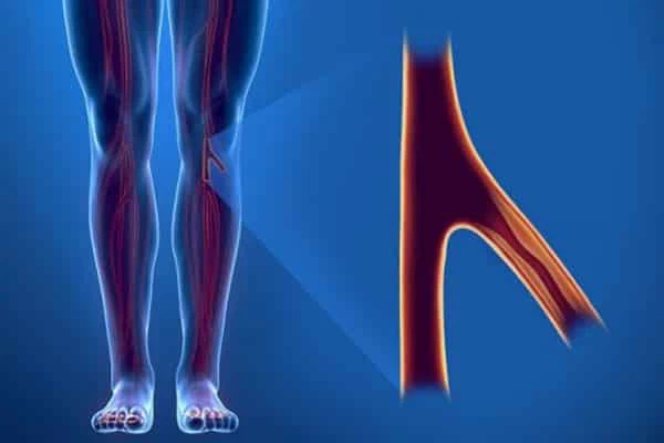 Bệnh lý động mạch chủ chi dưới: Mùa đông và những cơn đau chân