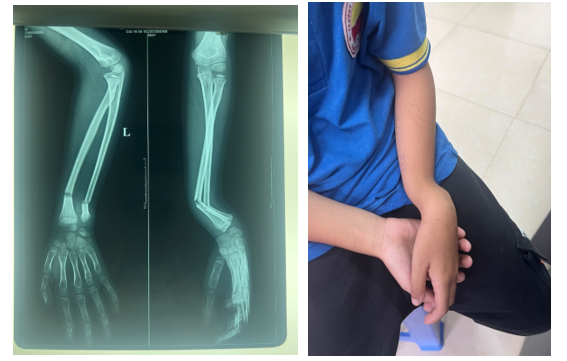 Gãy 1/3 dưới xương cẳng tay nên làm gì?