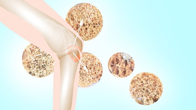 Chẩn đoán loãng xương và dấu hiệu nhận biết loãng xương