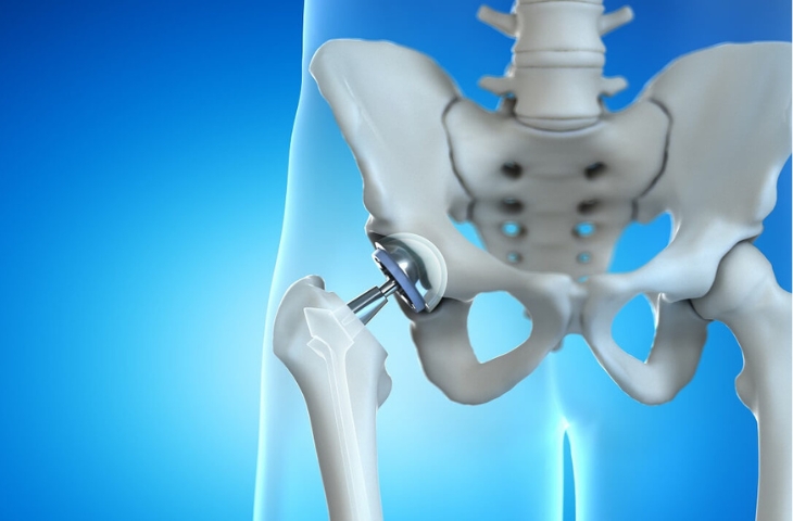 Chỉ định phẫu thuật thay khớp háng ở người viêm khớp dạng thấp