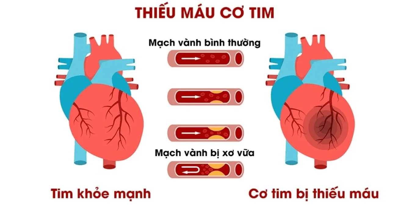 Bệnh thiếu máu cơ tim: Biểu hiện, nguyên nhân và cách điều trị