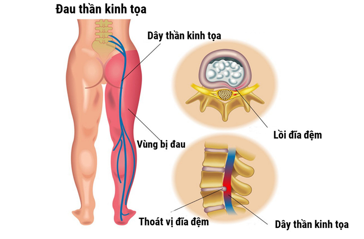 Cách chữa đau thần kinh tọa, có khỏi không?