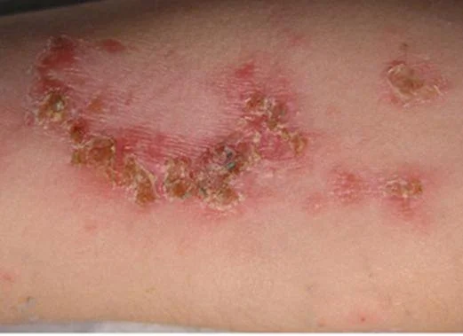 Các bệnh ngoài da thường gặp ở trẻ nhỏ