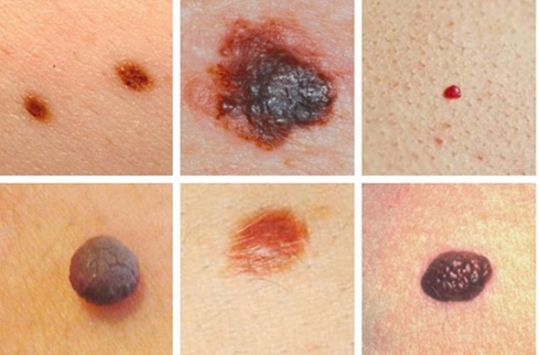 Ung thư da có bao nhiêu loại? Giải mã bí ẩn căn bệnh ung thư da