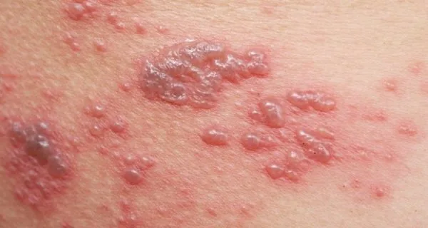 Bệnh zona thần kinh có lây không ?