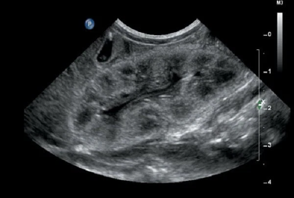 Bệnh cầu thận màng: Triệu chứng, chẩn đoán và điều trị