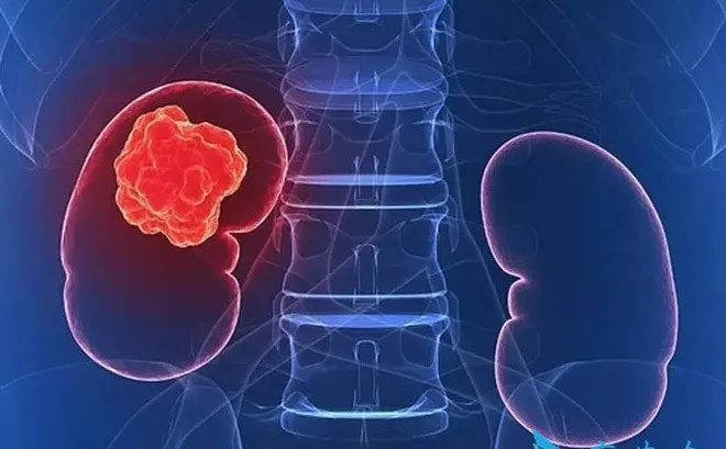 Tình trạng bệnh nhân ung thư ngày càng trẻ