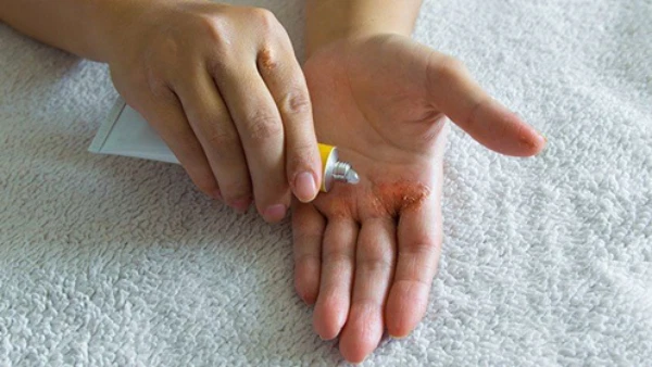 Da nhiễm corticoid: Nguyên nhân, dấu hiệu nhận biết và cách điều trị