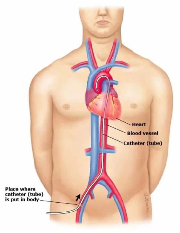 Y học thường thức: Can thiệp nội mạch – Endovascular Surgery