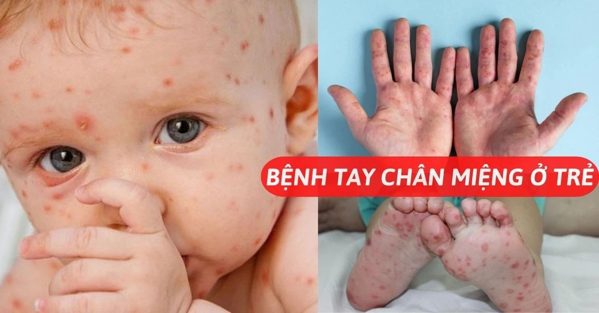 Nguyên nhân nào gây nên bệnh tay chân miệng ?