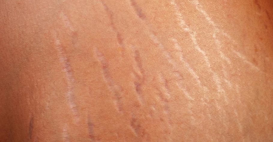 Rạn da đỏ, rạn da trắng là gì? 3 cách trị rạn da hiệu quả