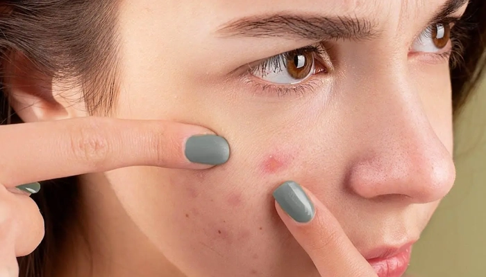 Nặn Mụn Đúng Cách: Hướng Dẫn An Toàn Giúp Tránh Thâm Và Sẹo