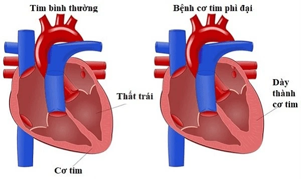Bệnh cơ tim phì đại: nguyên nhân, triệu chứng và điều trị