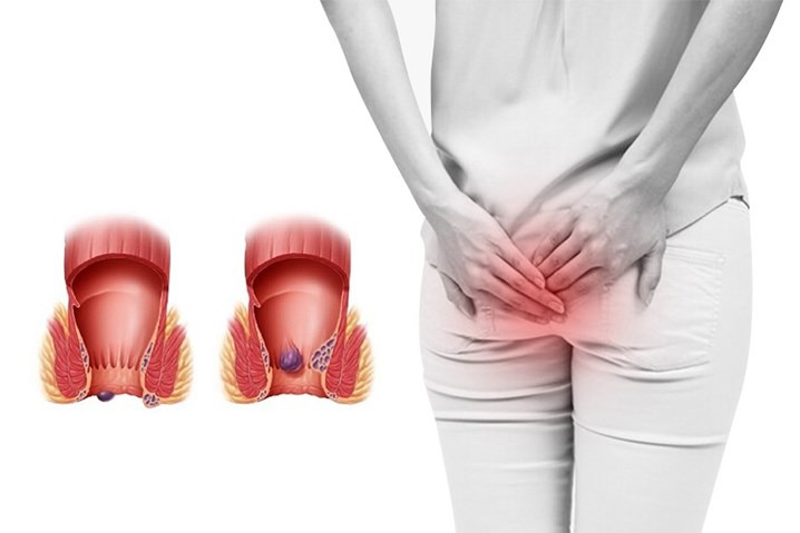 Thói quen xấu khiến nhiều người có nguy cơ mắc bệnh trĩ