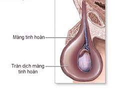 Tràn dịch màng tinh hoàn: bệnh lý không nên xem nhẹ