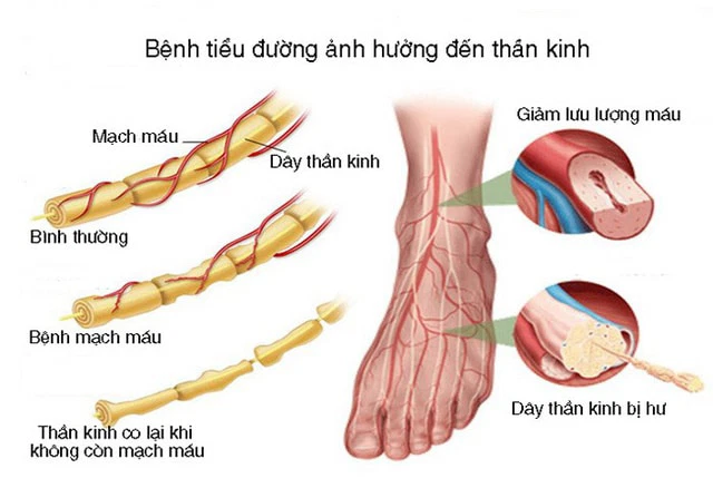 Biến chứng tiểu đường gây loét da: triệu chứng và hướng dẫn cách điều trị
