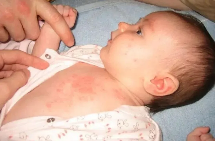 6 dấu hiệu nổi mề đay ở trẻ và cách chăm sóc