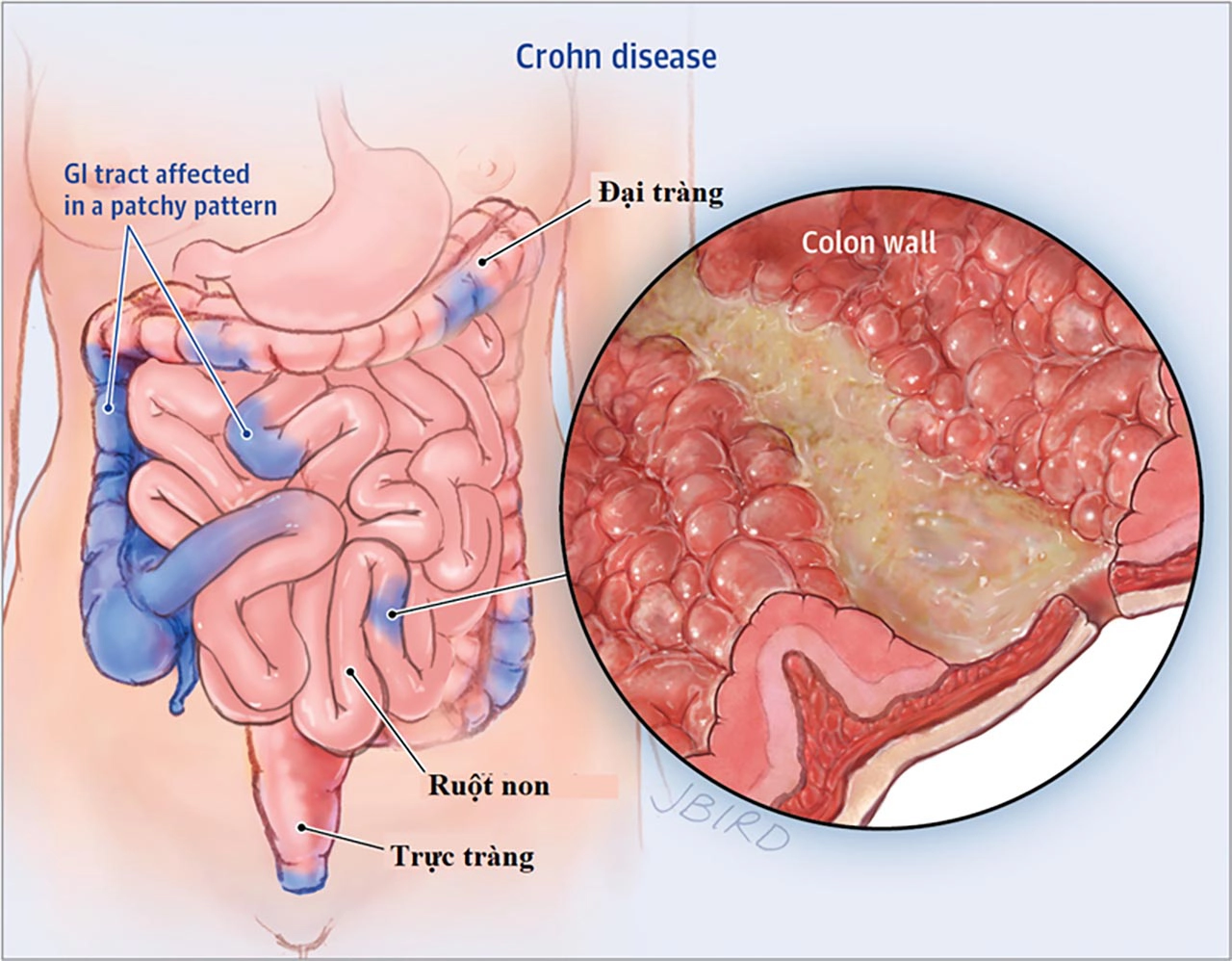 Bệnh Crohn: nguyên nhân, triệu chứng và cách điều trị