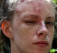 Bệnh zona thần kinh ở mặt và những điều cần biết