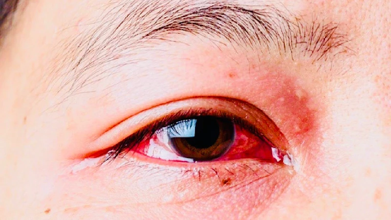 Bệnh đau mắt đỏ: Nguyên nhân và triệu chứng cần chú ý