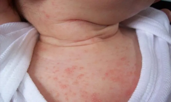 Phòng tránh rôm sảy cho trẻ vào mùa hè