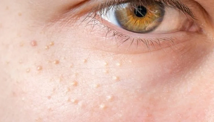 Mụn Thịt Là Gì? Nguyên Nhân, Triệu Chứng Và Cách Điều Trị Hiệu Quả