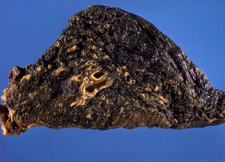 Bệnh bụi phổi: Phòng bệnh hơn chữa bệnh!