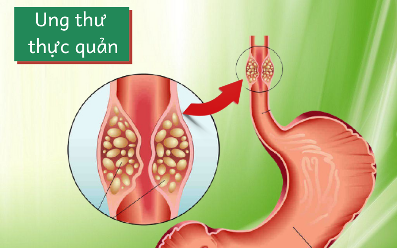 Cách chăm sóc người bệnh ung thư thực quản