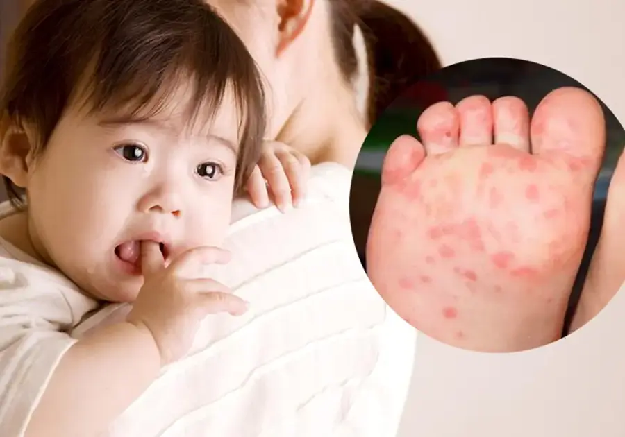 BÀI TUYÊN TRUYỀN PHÒNG CHỐNG TAY CHÂN MIỆNG Ở TRẺ EM