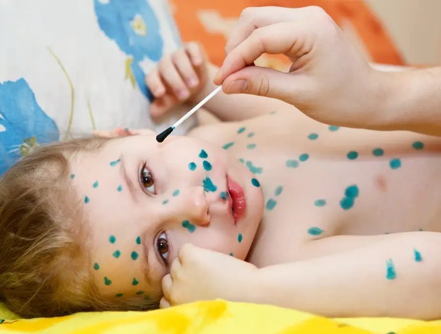 Thuốc nào dùng điều trị thuỷ đậu?