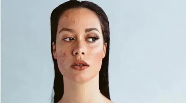 5 dấu hiệu cảnh báo lão hóa da không nên bỏ qua